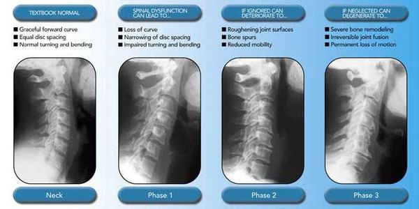 Chiropractor Stamford CT, arthritis care, disc degeneration, bone spurs, spinal degeneration care