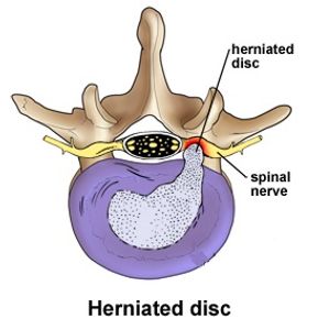 Chiropractor Stamford CT, disc bulge, disc herniation, disc hernia, slipped disc, ruptured disc