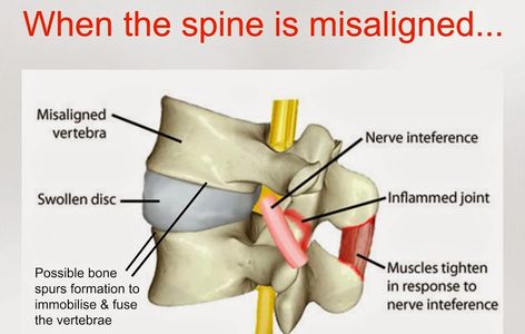chiropractor Stamford CT, pinched nerve, spine misalignment, pain, subluxation, what is chiropractic