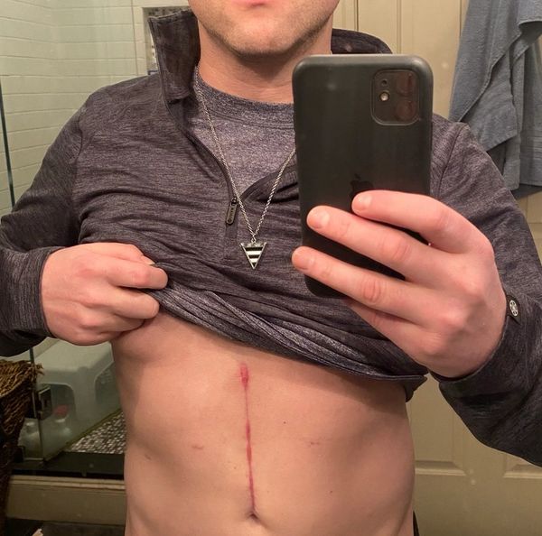 Man shows a healing vertical scar on his abdomen in a bathroom mirror selfie.