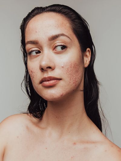 L'acné est un problème qui affecte beaucoup d'aspects dans la vie des personnes atteintes.