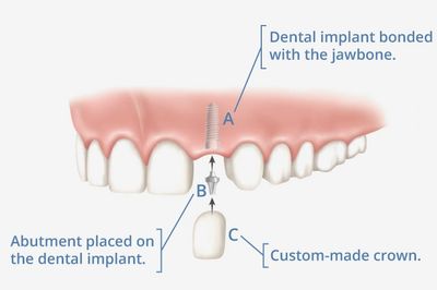 Diagramatic view of a single toth implant restoration.