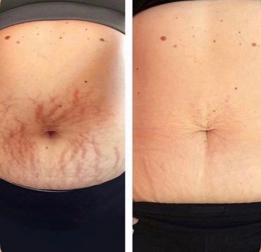 Before and after stretch mark reduction on the abdomen.