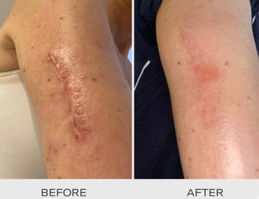 Before and after arm scar healing.