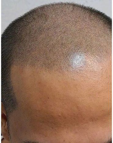 Close-up of a balding man's scalp with short hair.