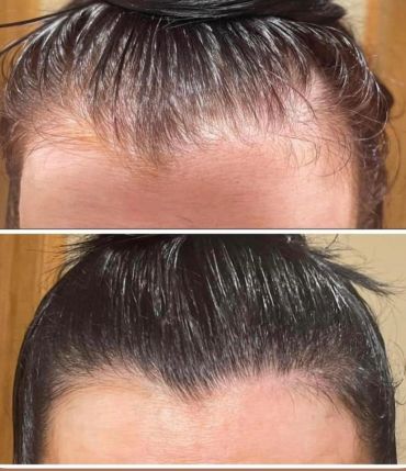 Hairline improvement before and after.