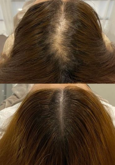 Before and after hair regrowth treatment showing reduced thinning.