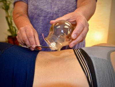 Jenn treating a patient with fire cupping 