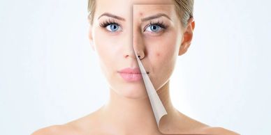 Blackheads or congestion can be treated with microdermabrasion & ultrasonic blade.