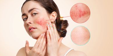 Skin redness & skin sensitivity can be treated with Dermalogica Pro Skin facials & LED.