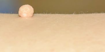 Skin Tag Removal is done using diathermy t