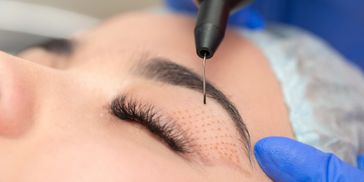 Plasma Eye Lift (Plasma Pen Fibroblast) tightens & lifts baggy skin around the eye area.