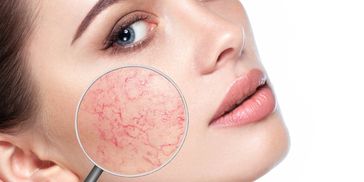 Red Vein Removal uses diathermy to remove them from the face.