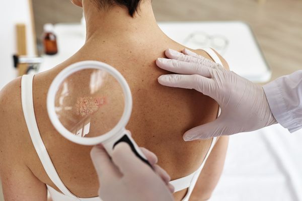 A dermatologist examines a patient's back using a magnifying glass, highlighting a skin condition