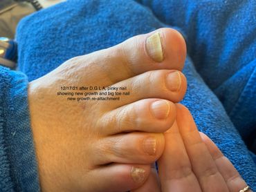 Reattached fungus toenails
#reattachedfungustoenails
