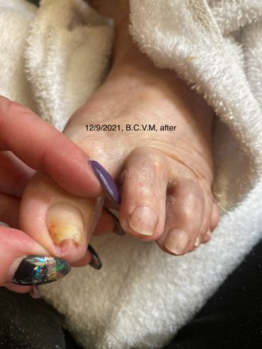 Extreme ingrown toe nail
#extremeingrowntoenails