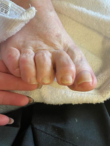 Treated ingrown toenails
#treatedingrowntoenails