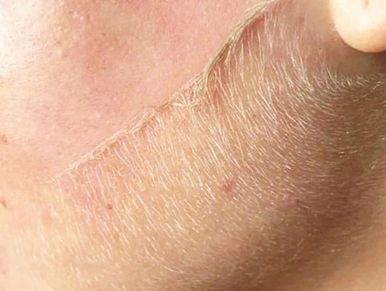 Dermaplaning