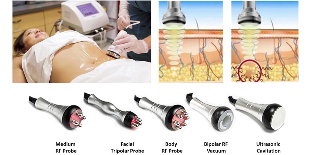 Ultrasonic cavitation