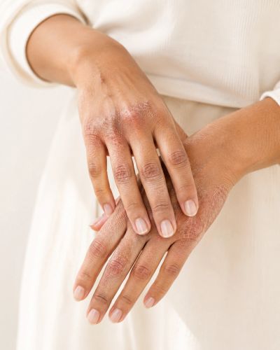 Eczema on hands