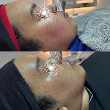 advanced skin care spa face beauty treatments Saint Paul acne pimples facial hormonal acne breakouts