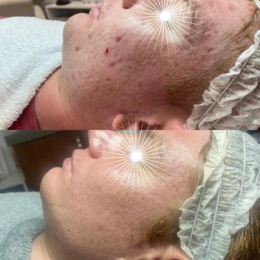 advanced skin care spa face beauty treatments Saint Paul acne pimples facial hormonal acne breakouts