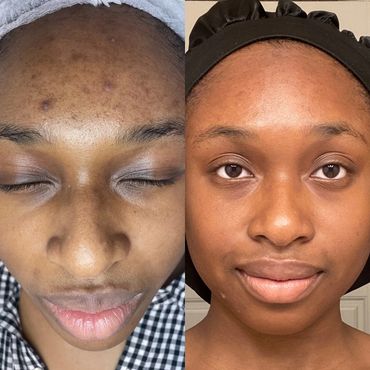 Acne Facial Esthetician Acne Minnesota spa Saint Paul microneedle peel pimple product DARK SAINTPAUL
