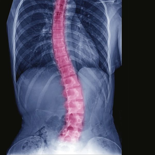 Scoliosis