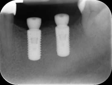 Implants were tested for intergration.