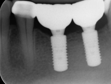 Final implant crowns on Xray