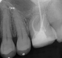 Root canal