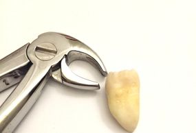 Tooth extraction