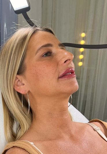 Our gorgeous client was thrilled with her 1ml of lip filler. We defined the border and added volume.