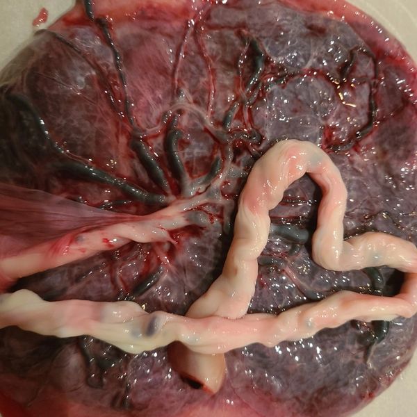 Close-up of a placenta with umbilical cord.