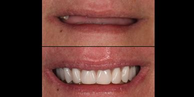 Η ολική ή η μερική νωδότητα (απώλεια όλων ή ορισμένων δοντιών) έχει σημαντικές επιπτώσεις στην καθημ