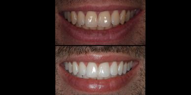Η λεύκανση των φυσικών δοντιών πραγματοποιείται σε σύντομο χρονικό διάστημα. Είναι αβλαβής και αλλάζ