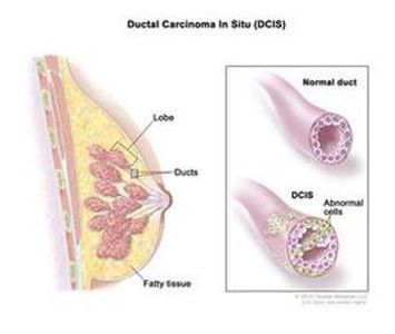 Ductal carcinoma in situ breast cancer awareness information Thuggizzle Cares