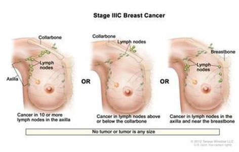 stage 3C breast cancer awareness information Thuggizzle Cares