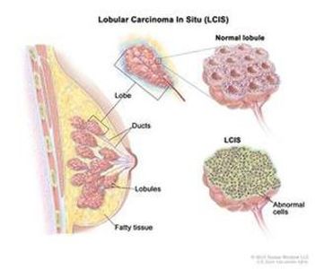 Lobular carcinoma in situ breast cancer awareness information Thuggizzle Cares