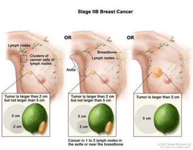stage 2B breast cancer awareness information Thuggizzle Cares