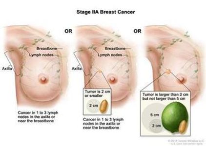 Stage 2A breast cancer awareness information Thuggizzle Cares