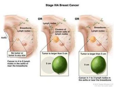 stage 3A breast cancer awareness information Thuggizzle Cares