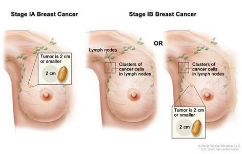 stage 1 breast cancer awareness information Thuggizzle Cares