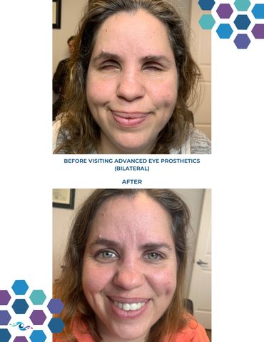 Before photo of a woman with both eyes removed and After photo wearing new prosthetic eyes.