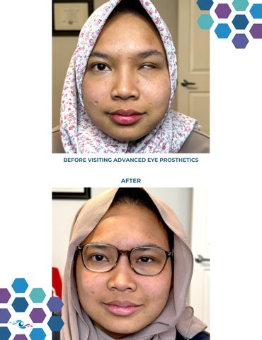 Before photo of a woman with a damaged live eye and After photo wearing a new scleral shell.