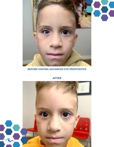 Before photo of a young boy wearing an old prosthetic eye and After photo wearing a new one.