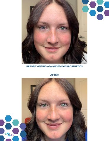 Before photo of a teenage girl wearing an old prosthetic eye and After photo wearing a new one.