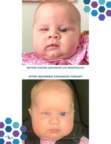 Before photo of a baby with a small live eye and After photo wearing a conformer.