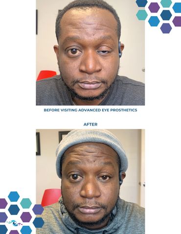 Before photo of a man wearing an old prosthetic eye and After photo wearing a new one.