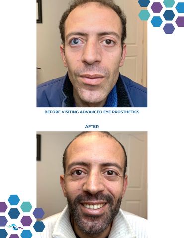 Before photo of a man wearing an old prosthetic eye and After photo wearing a new one.